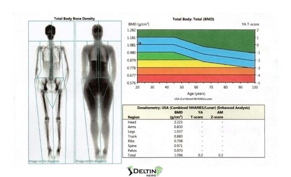 DEXA Scan, An Indian Cricket Selection Team Criteria